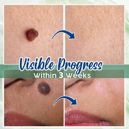 ActiveSkin mutieemaldusseerum - Image 2