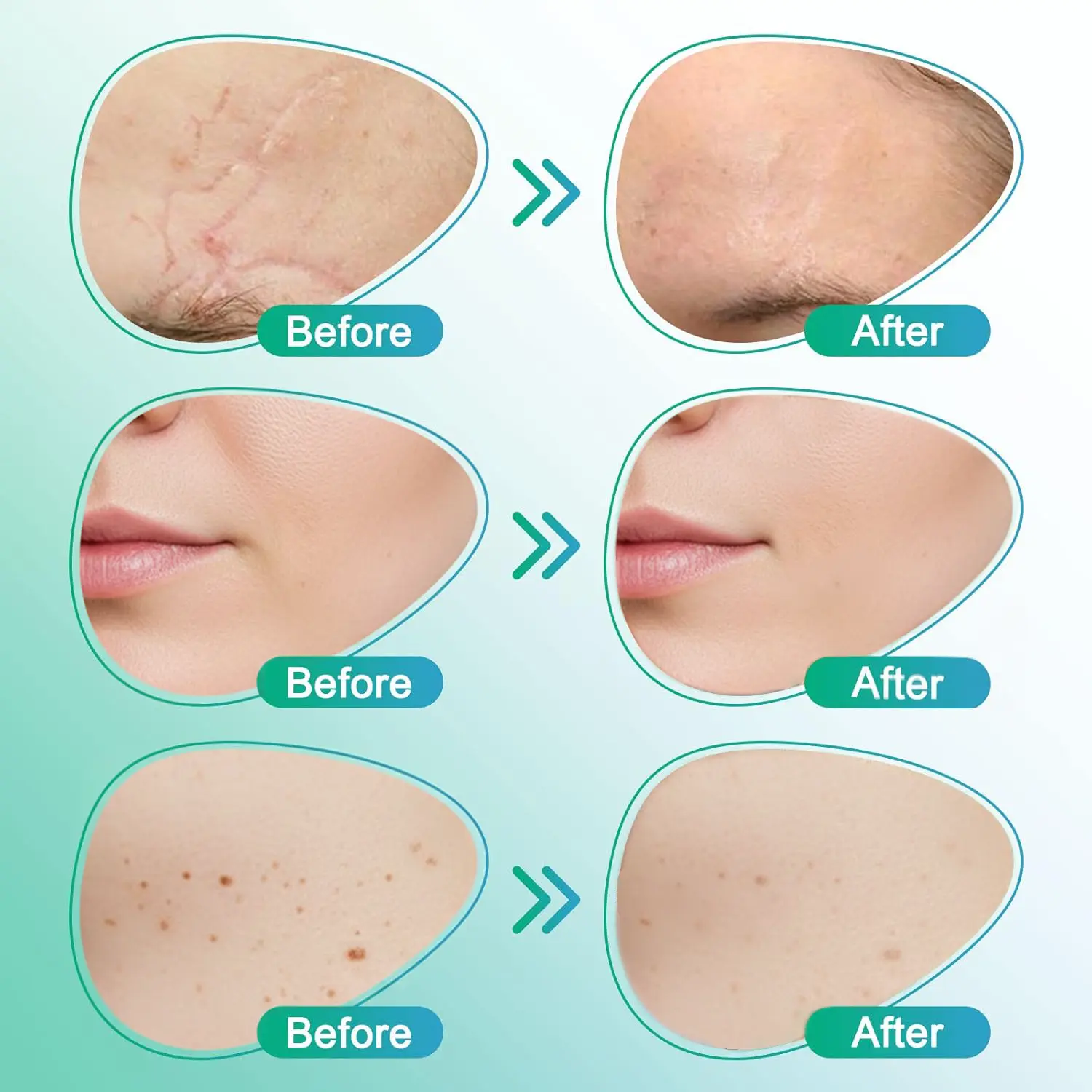 𝗖𝗮𝗿𝗲𝗕𝗿𝗲𝗲𝘇𝗲® 3-in-1 mikronõela hooldusplaaster - Image 5