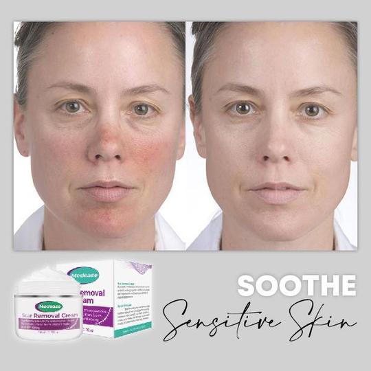 Medease Skin Rebound kreem - Image 6