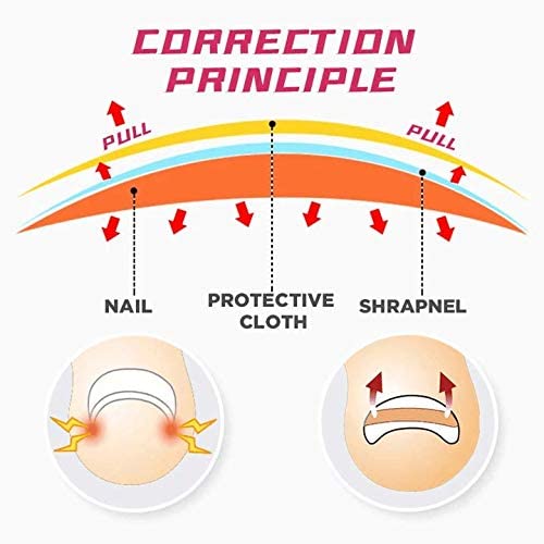 Sissekasvanud varbaküünte reguleerimise plaaster - Image 5
