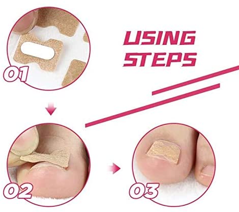 Sissekasvanud varbaküünte reguleerimise plaaster - Image 6