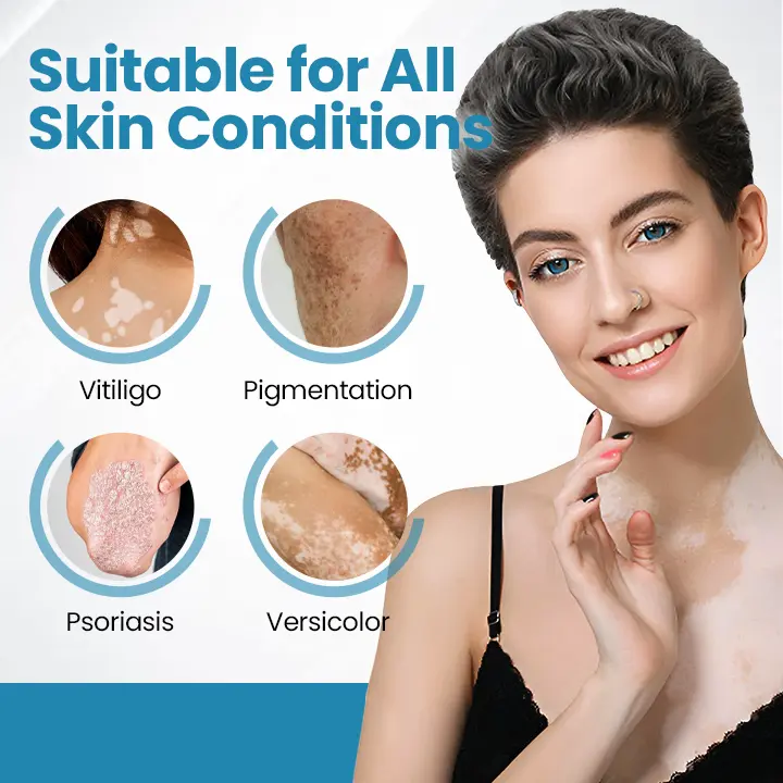Vitiligo raviseade Acezozla® DermaBeam - Image 2