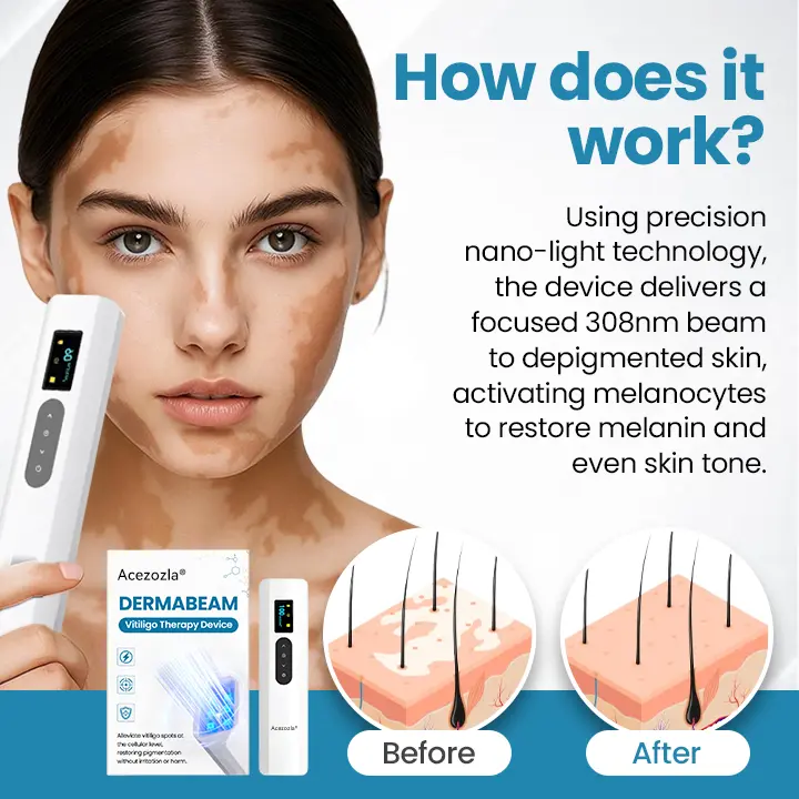 Vitiligo raviseade Acezozla® DermaBeam - Image 3