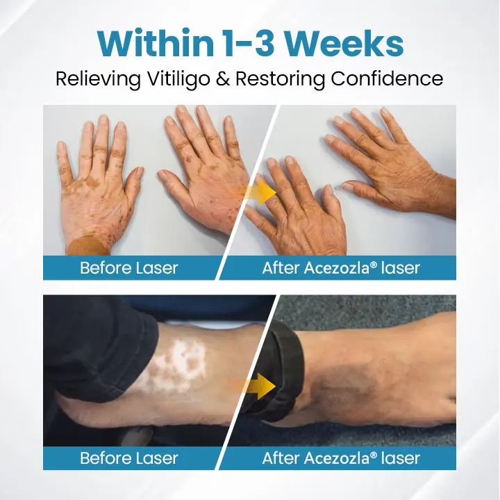Vitiligo raviseade Acezozla® DermaBeam - Image 4