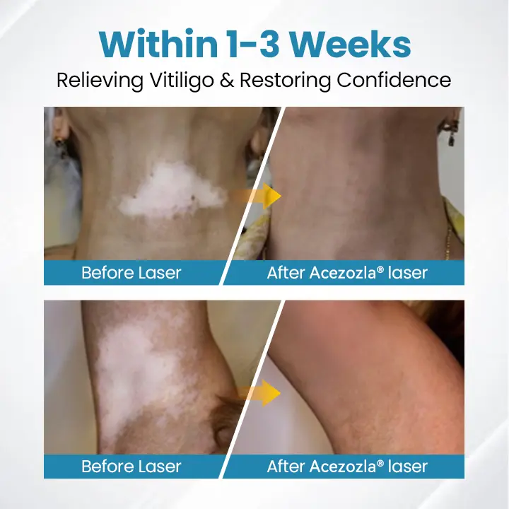 Vitiligo raviseade Acezozla® DermaBeam - Image 5