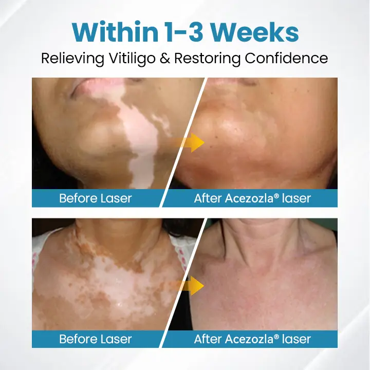 Vitiligo raviseade Acezozla® DermaBeam - Image 7