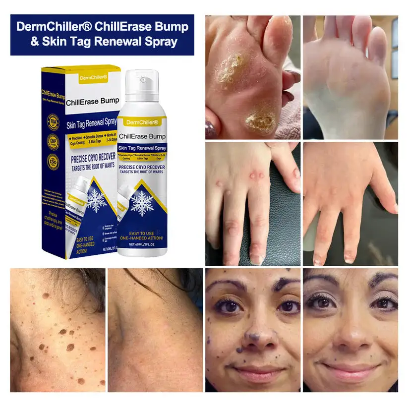 DermChiller® ChillErase Bump & Skin Tag Renewal Spray - Image 2