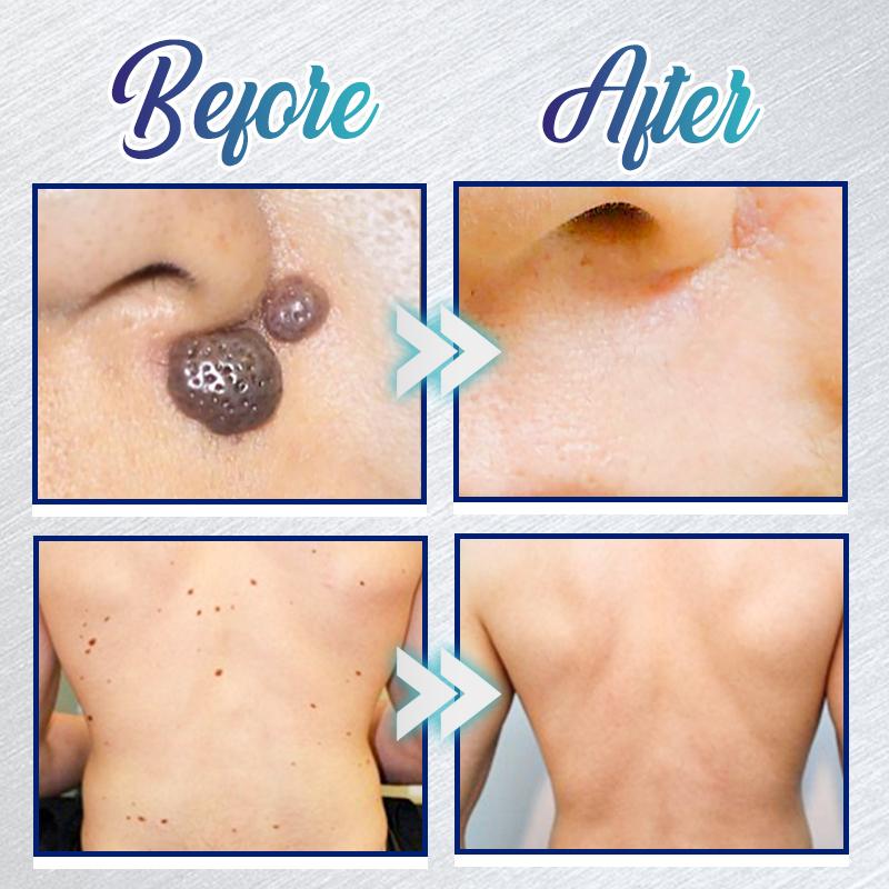 Kohene plekkide eemaldamise geel - Image 3