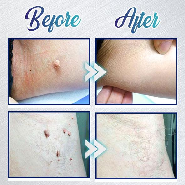 Kohene plekkide eemaldamise geel - Image 4