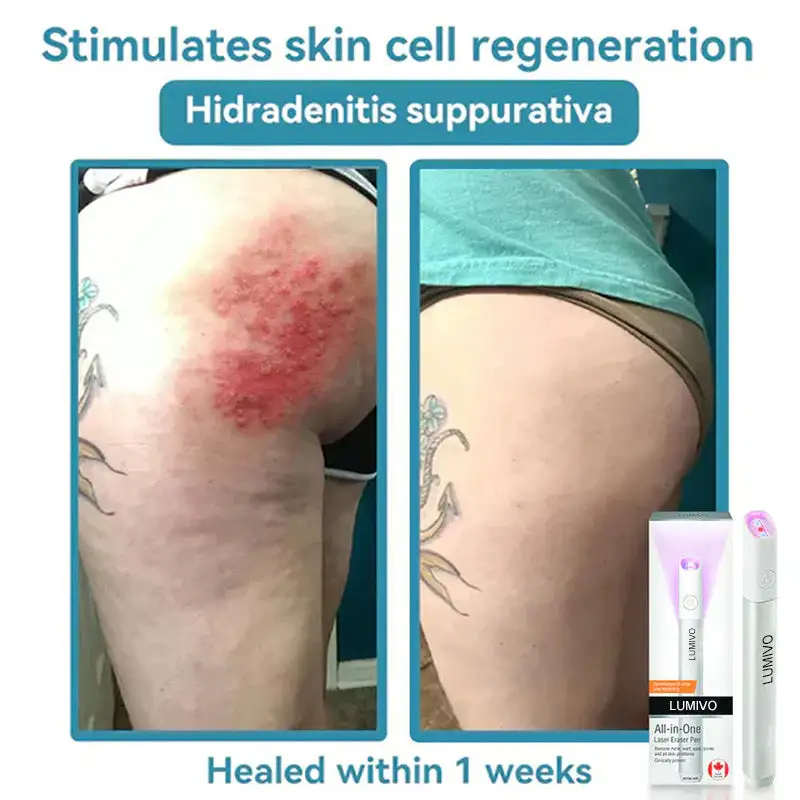 LUMIVO™ kõik-ühes CO₂ laserkustutuspliiats - Image 12